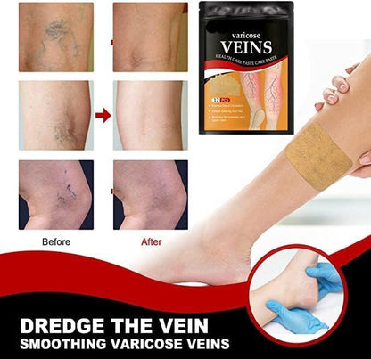 Varicose veins tape